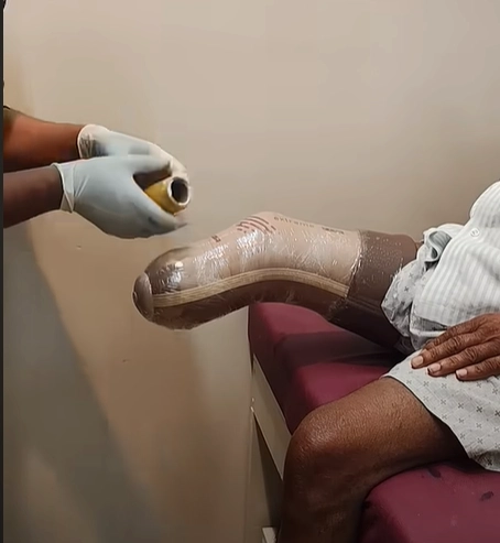 Fitting and Fabrication of Prosthetics at Vispala