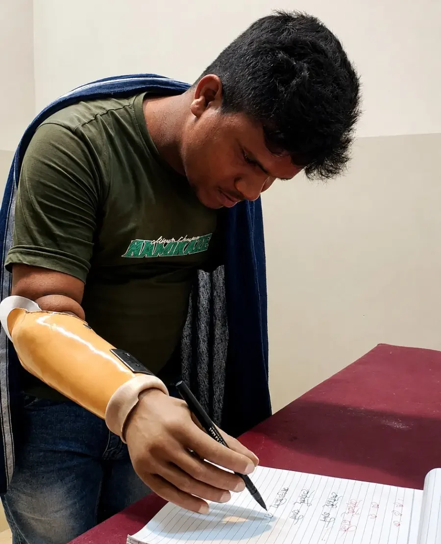 patient with hand prosthetic of Vispala Technologies